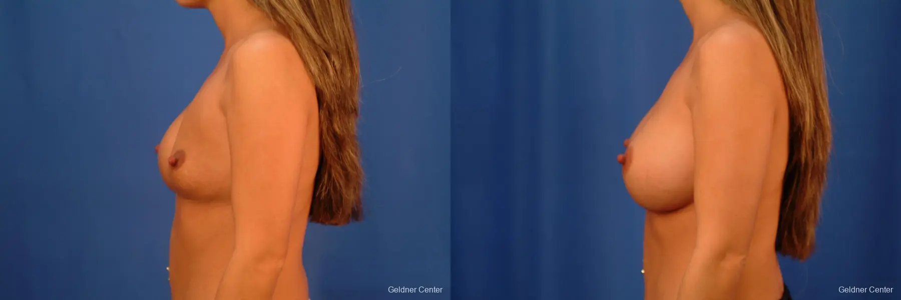 Chicago Breast Augmentation 2526 - Before and After 4