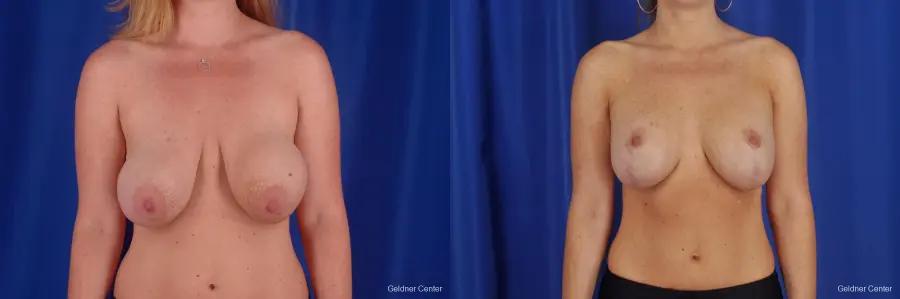 Breast Augmentation Steeterville, Chicago 2292 - Before and After