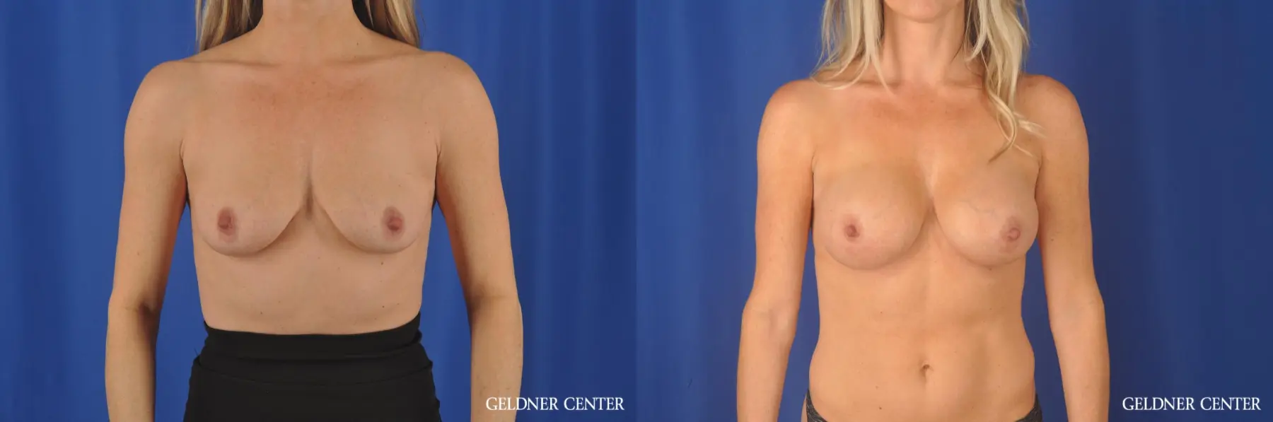 Breast Augmentation Hinsdale, Chicago 11861 - Before and After