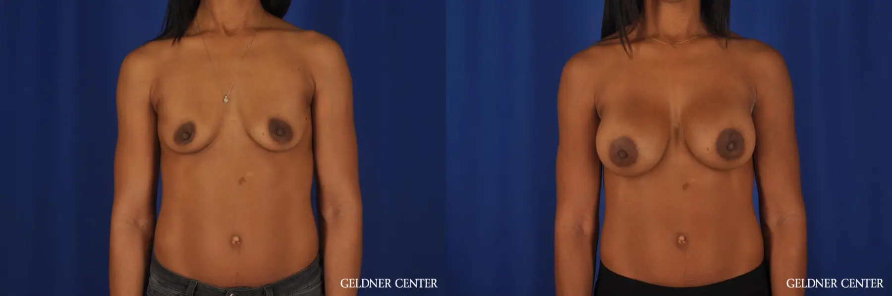 Chicago Breast Augmentation 4291 - Before and After