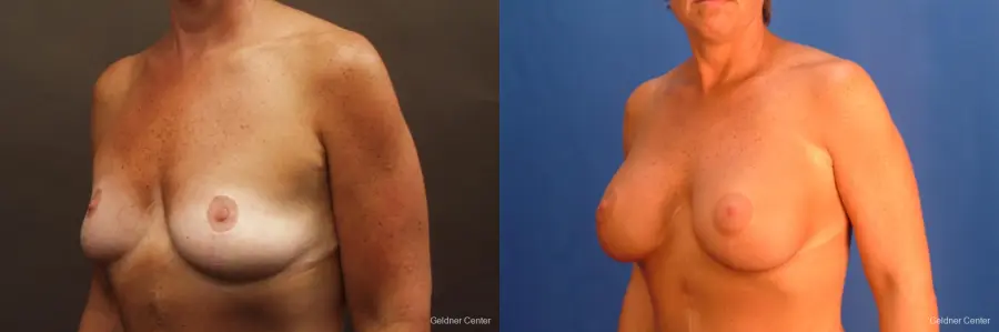 Chicago Breast Augmentation 2524 - Before and After 3