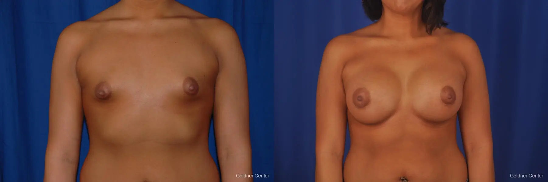 Biplanar Subpectoral Breast Augmantation 500cc - Before and After