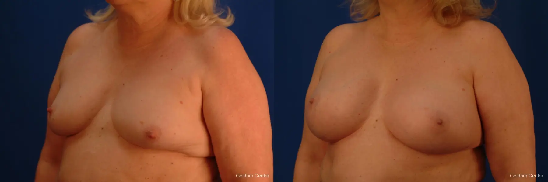 Chicago Breast Augmentation 2429 - Before and After 4