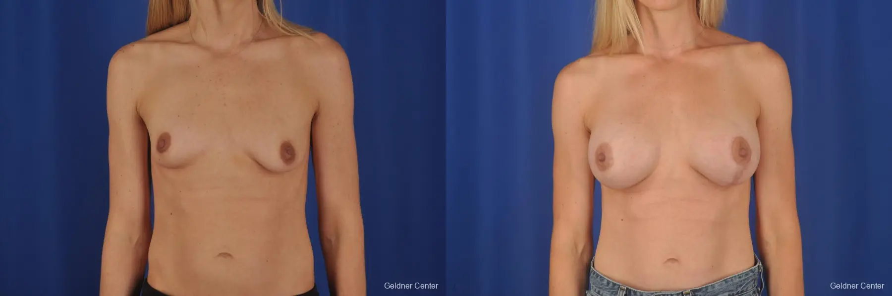 Chicago Breast Augmentation 6653 - Before and After