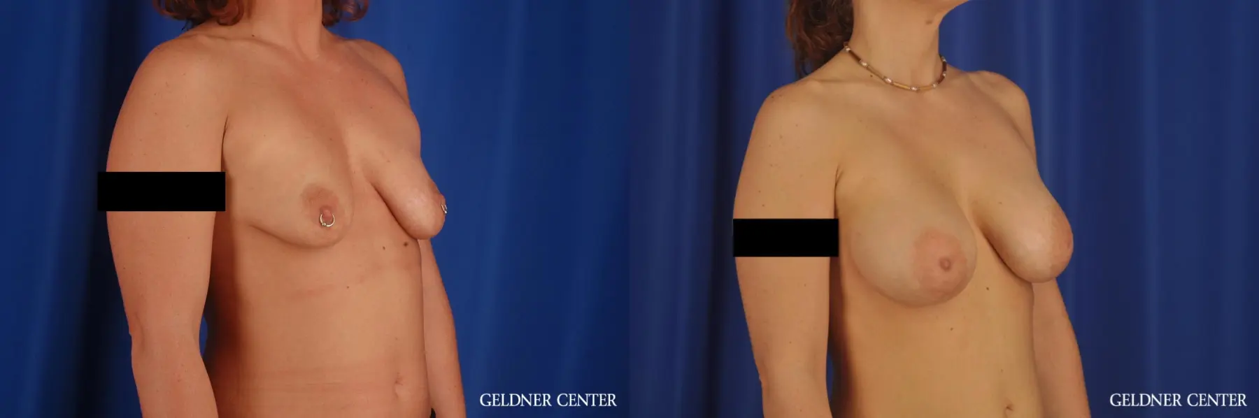 Breast Augmentation: Patient 172 - Before and After 2