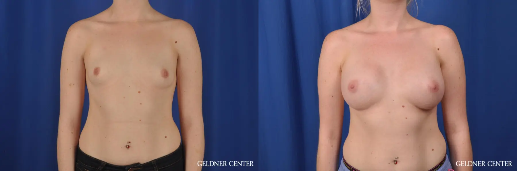 Biplanar Subpectoral 300cc - Before and After