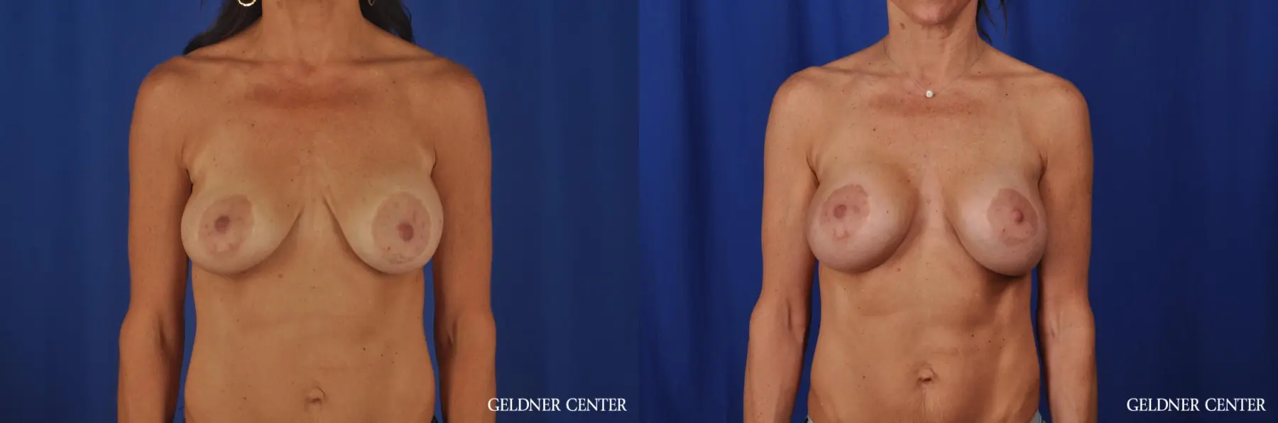 Breast Augmentation Streeterville, Chicago 5470 - Before and After