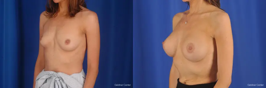 Breast Augmentation Lake Shore Dr, Chicago 2295 - Before and After 5