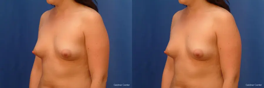 Chicago Breast Augmentation 2517 - Before and After 4