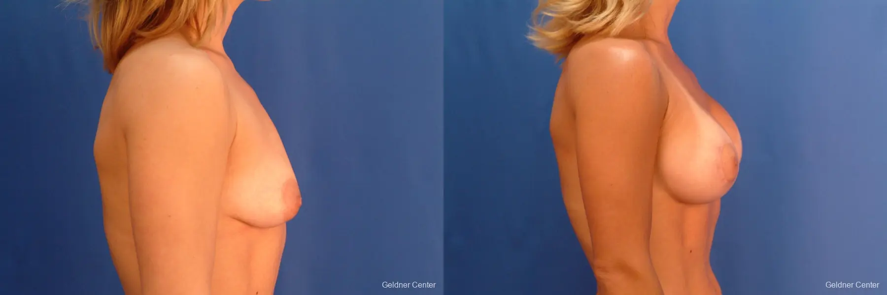 Breast Augmentation Lake Shore Dr, Chicago 2637 - Before and After 2