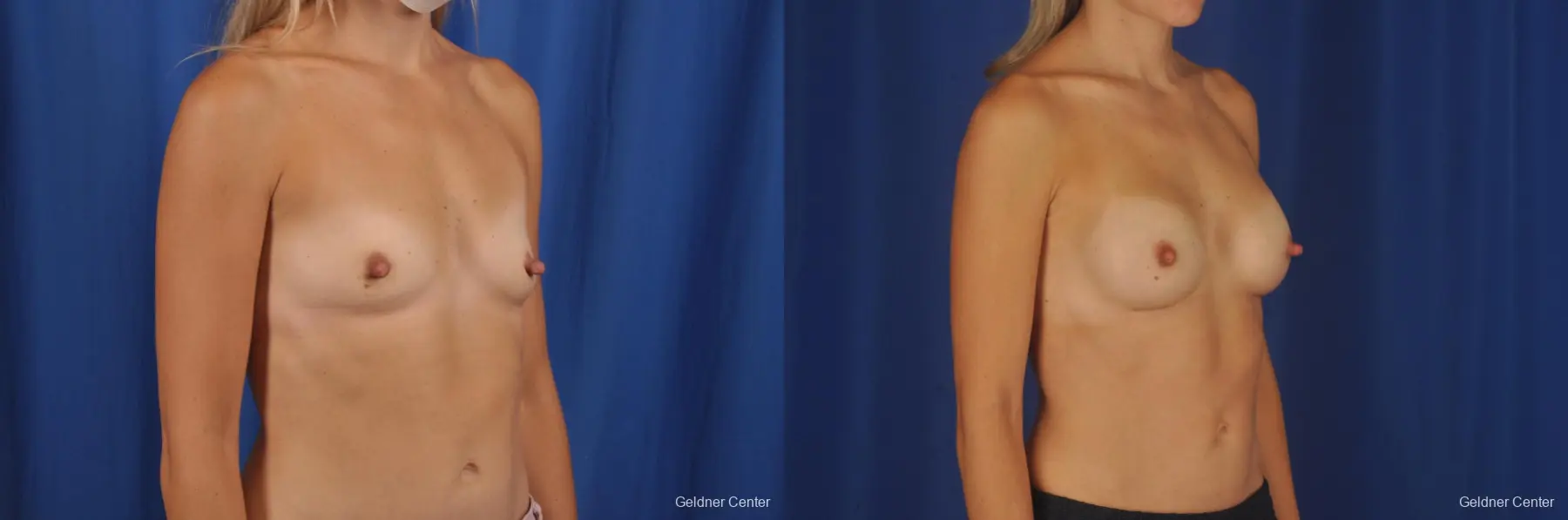 Breast Augmentation: Patient 189 - Before and After 3