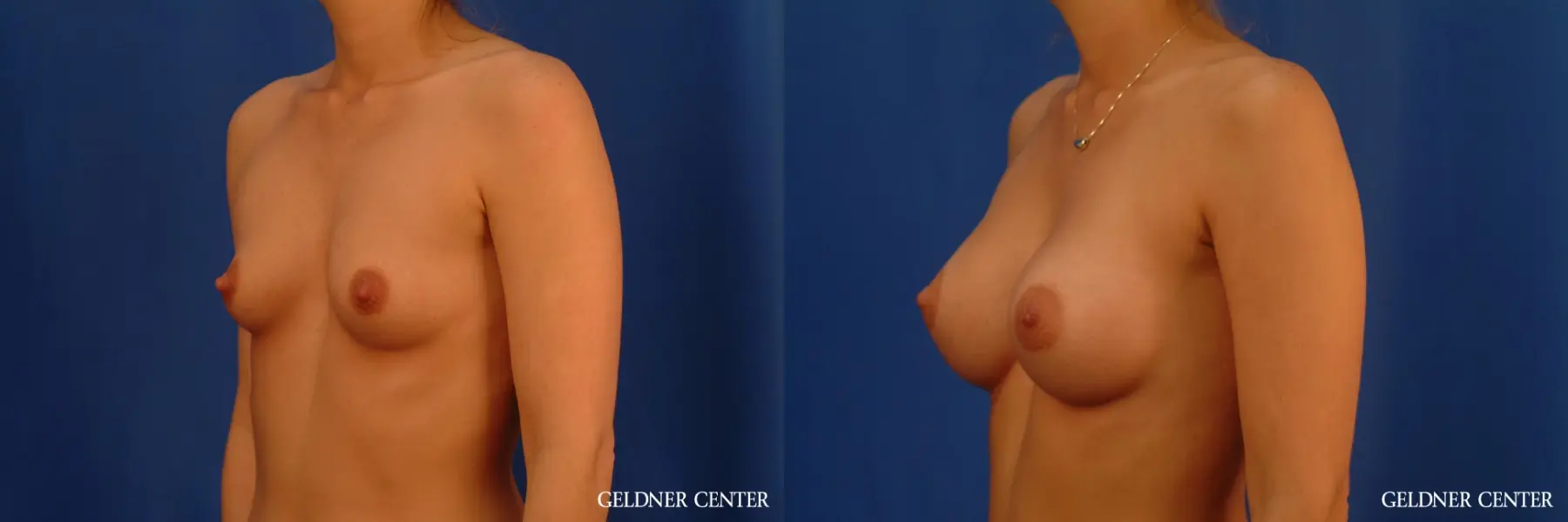 Breast Augmentation: Patient 182 - Before and After 4