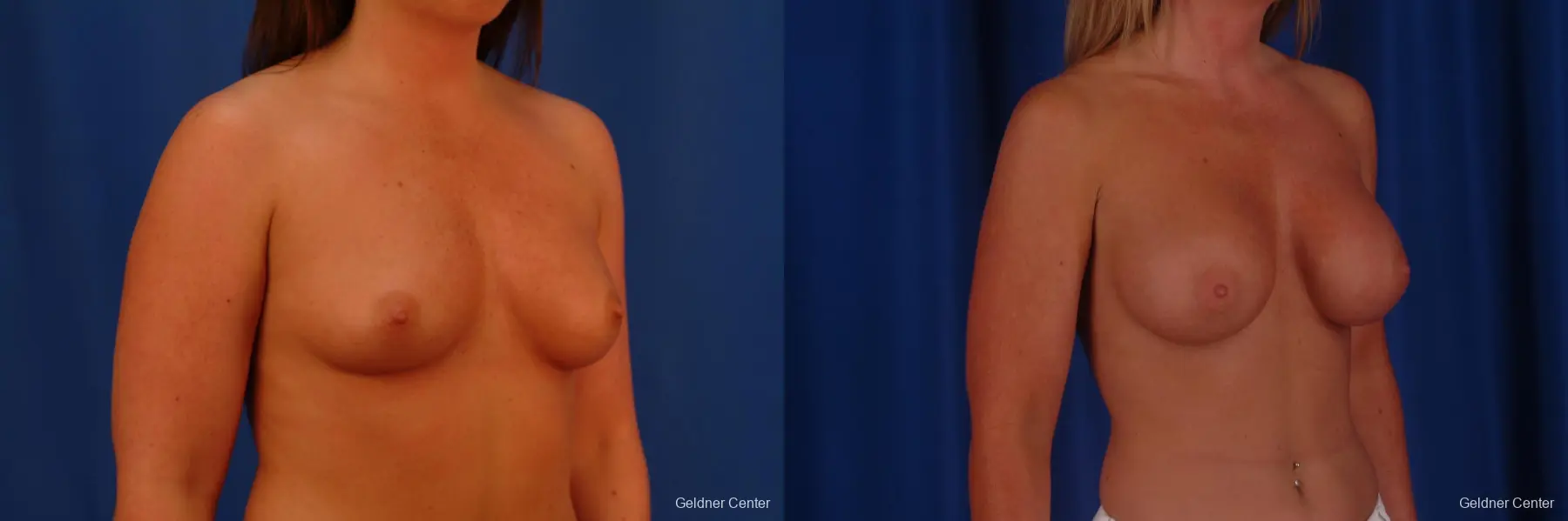 Chicago Breast Augmentation 2636 - Before and After 3