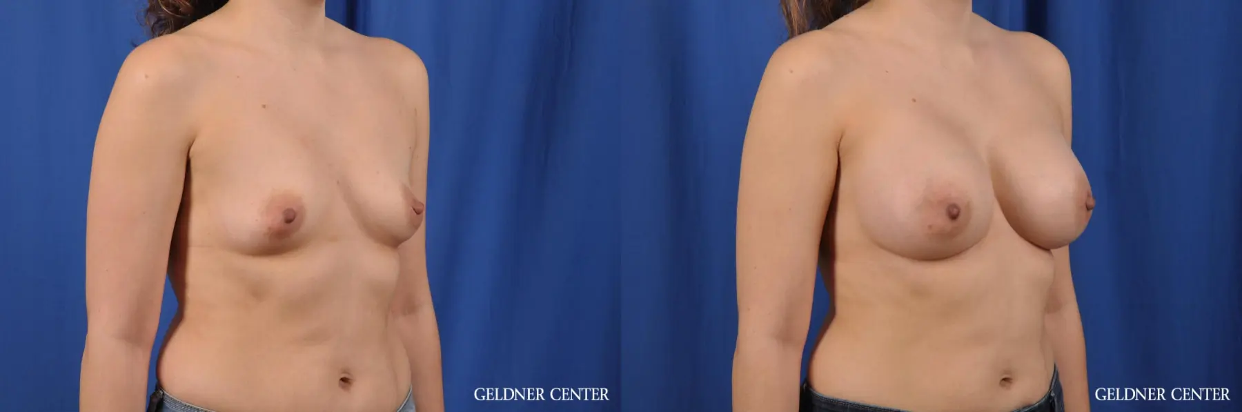Breast Augmentation: Patient 145 - Before and After 3