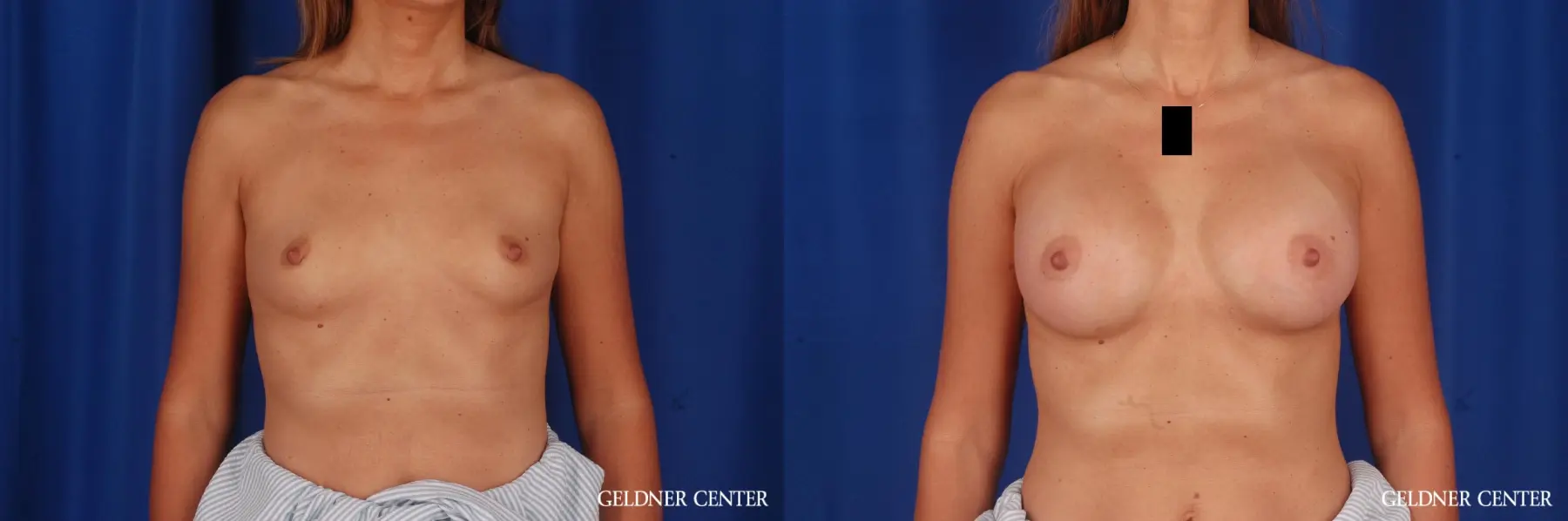 Breast Augmentation: Patient 174 - Before and After 1