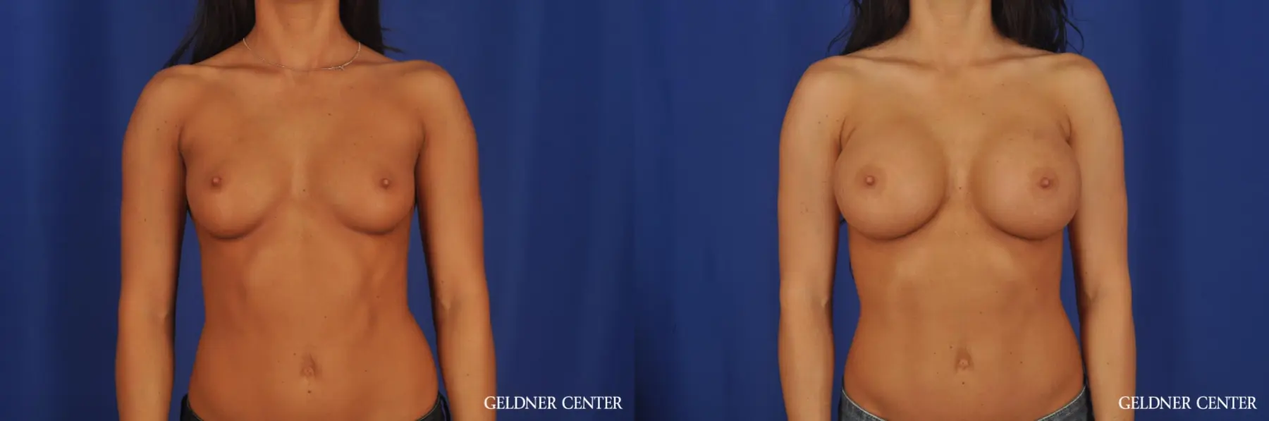 Breast Augmentation: Patient 176 - Before and After 1