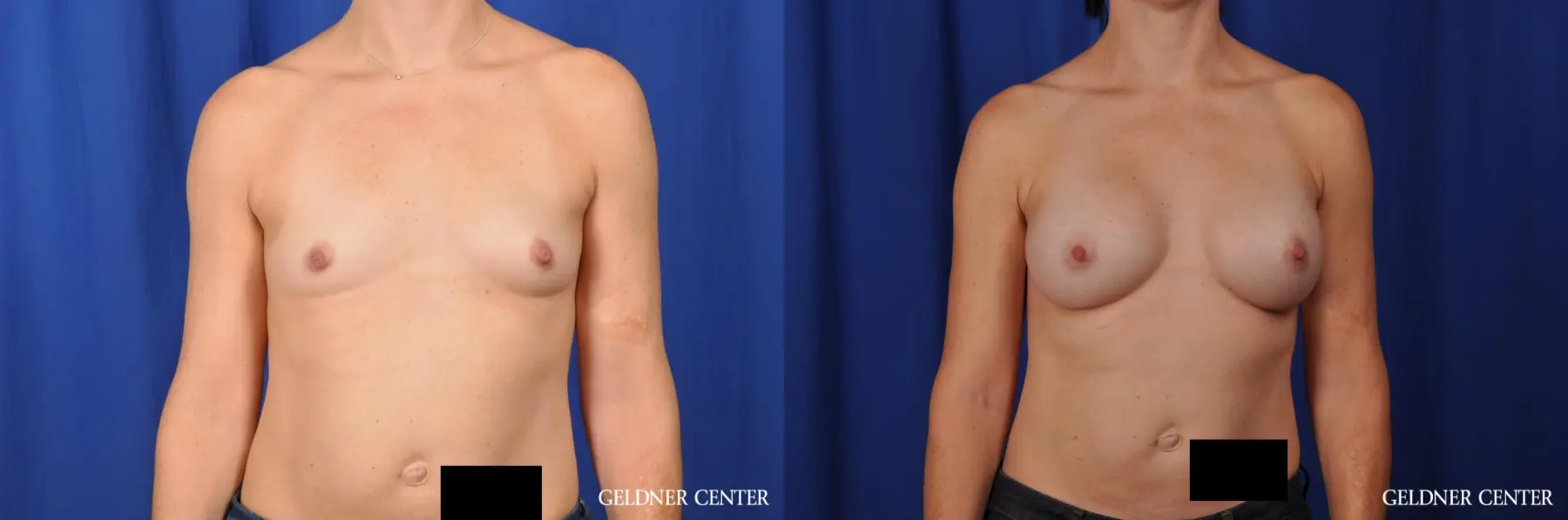 Breast Augmentation Lake Shore Dr, Chicago 4286 - Before and After