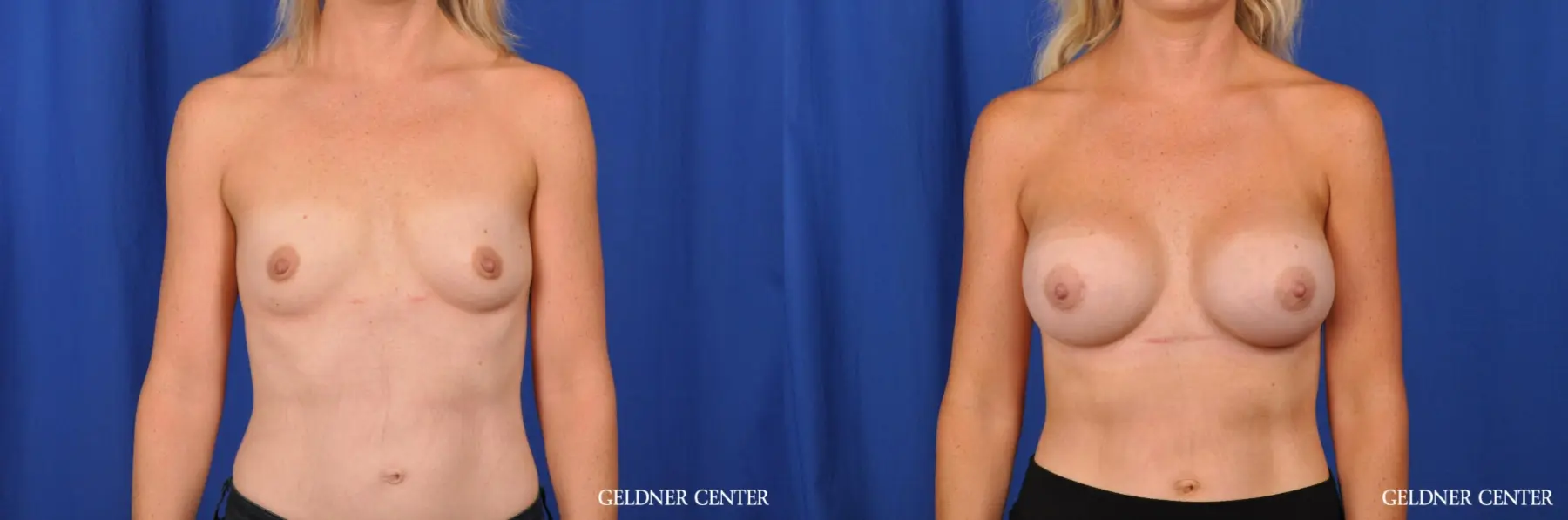 Chicago Breast Augmentation: Patient 1 - Before and After 1