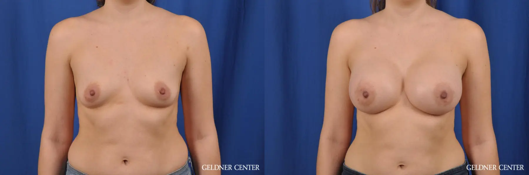 Biplanar Subpectoral 400cc - Before and After