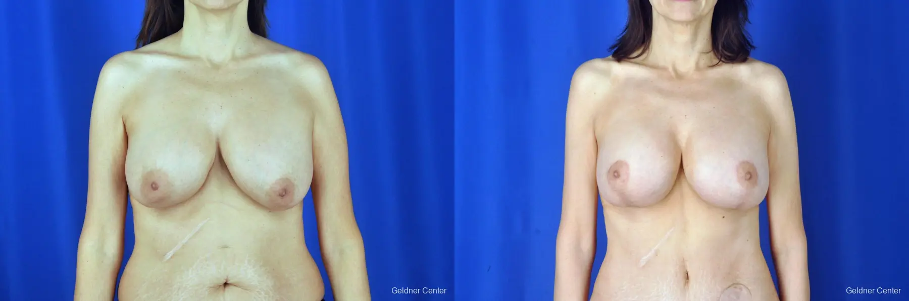 Breast Augmentation: Patient 6 - Before and After 1