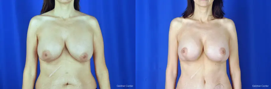 Breast Augmentation: Patient 5 - Before and After  
