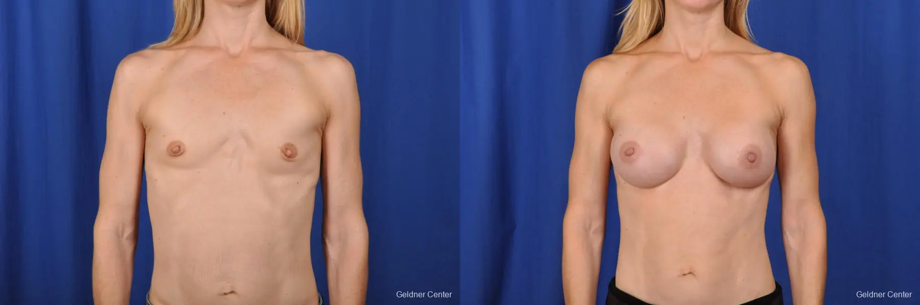 Chicago Breast Augmentation 2066 - Before and After 1