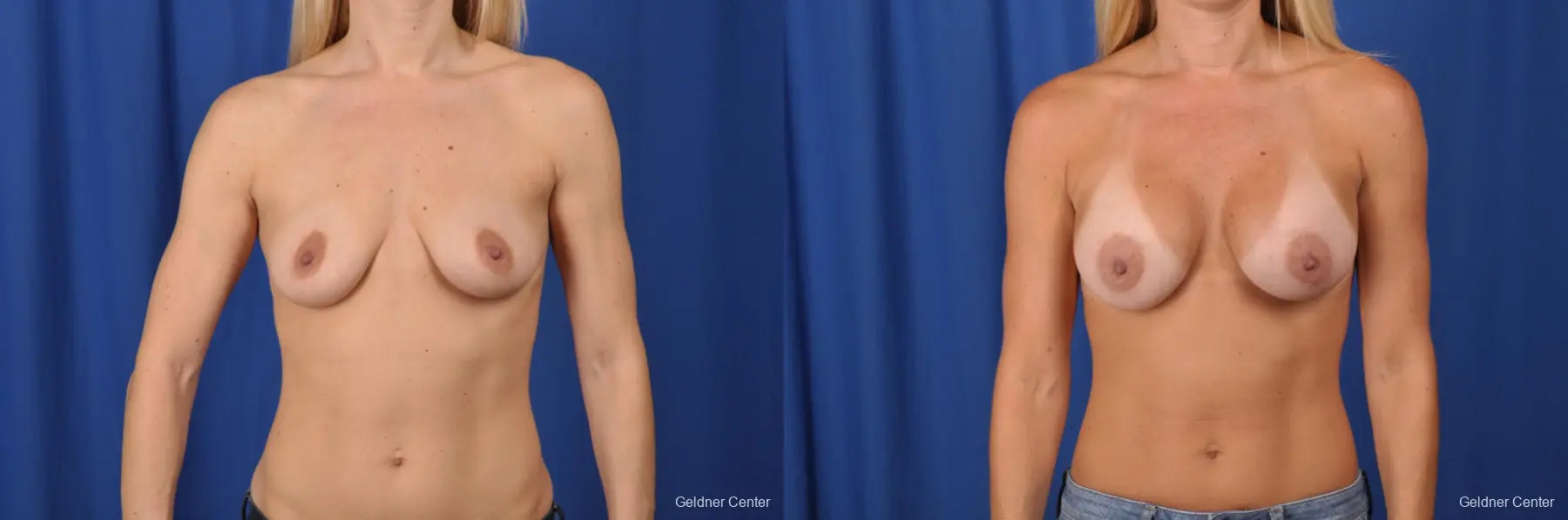 Biplanar subpectoral breast augmentaion 300cc - Before and After