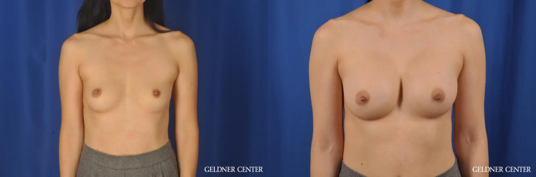 Transaxillary subpectoral biplanar breast augmentation 300cc - Before and After