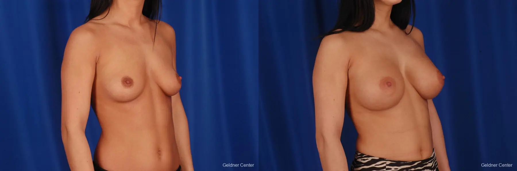 Breast Augmentation Lake Shore Dr, Chicago 2402 - Before and After 3
