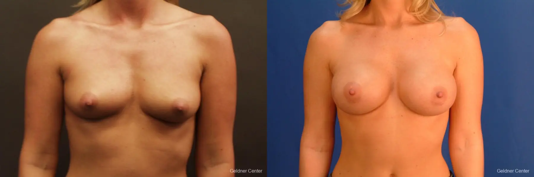 Breast Augmentation Streeterville, Chicago 2425 - Before and After 1