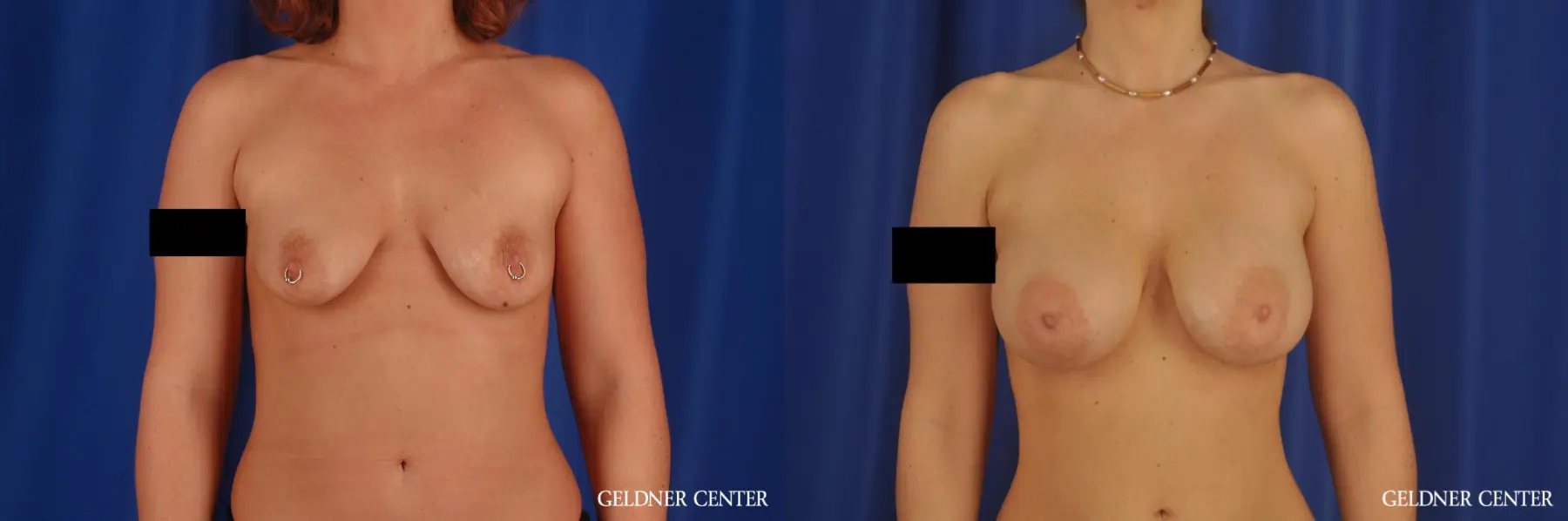 Breast Augmentation: Patient 172 - Before and After 1