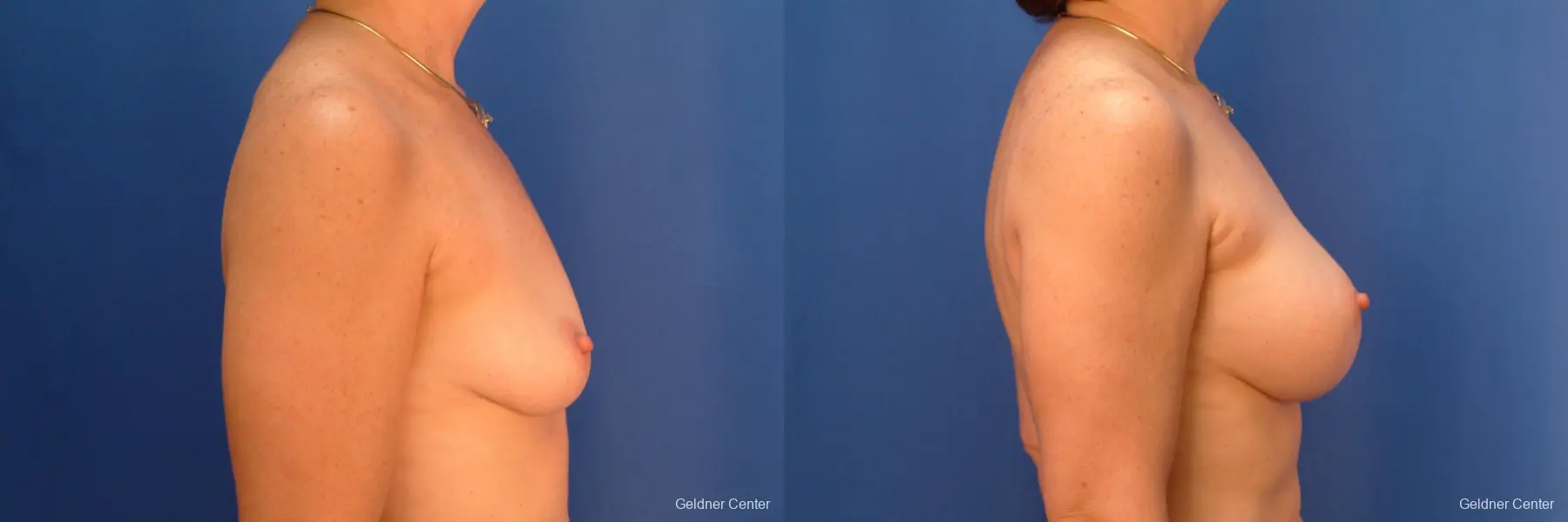 Breast Augmentation Hinsdale, Chicago 2541 - Before and After 2