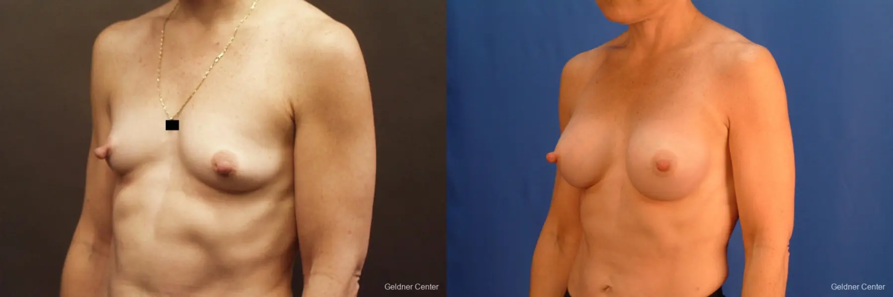 Chicago Breast Augmentation 2635 - Before and After 5
