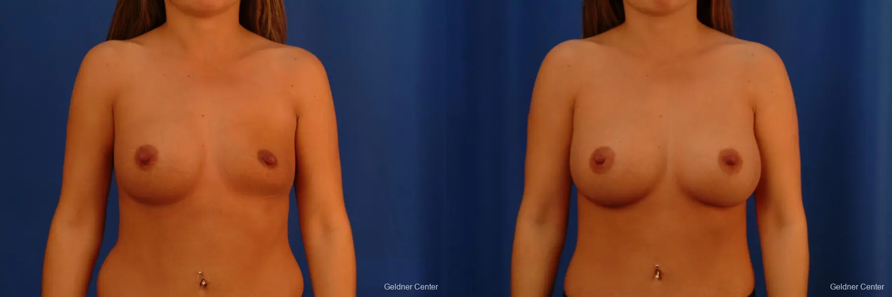 Chicago Breast Augmentation 2526 - Before and After