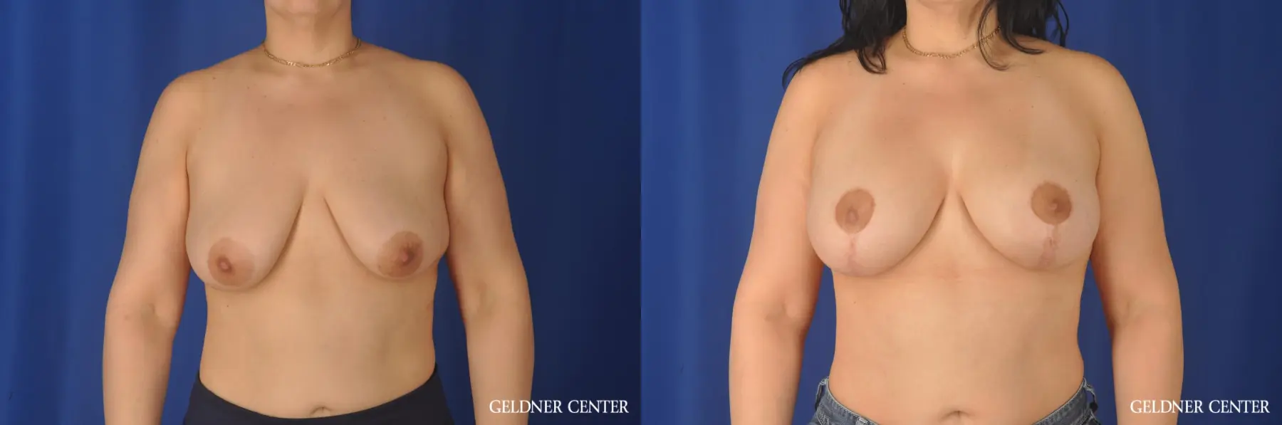 Augmentation with vertical  Mastopexy 400cc - Before and After