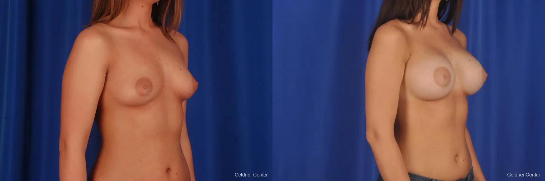 Chicago Breast Augmentation 2333 - Before and After 2