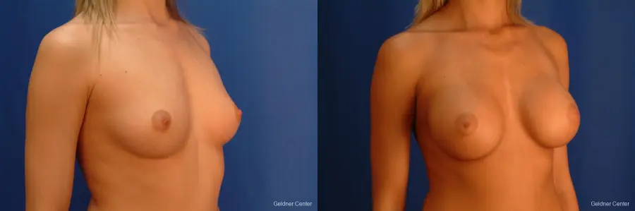 Chicago Breast Augmentation 2523 - Before and After 3