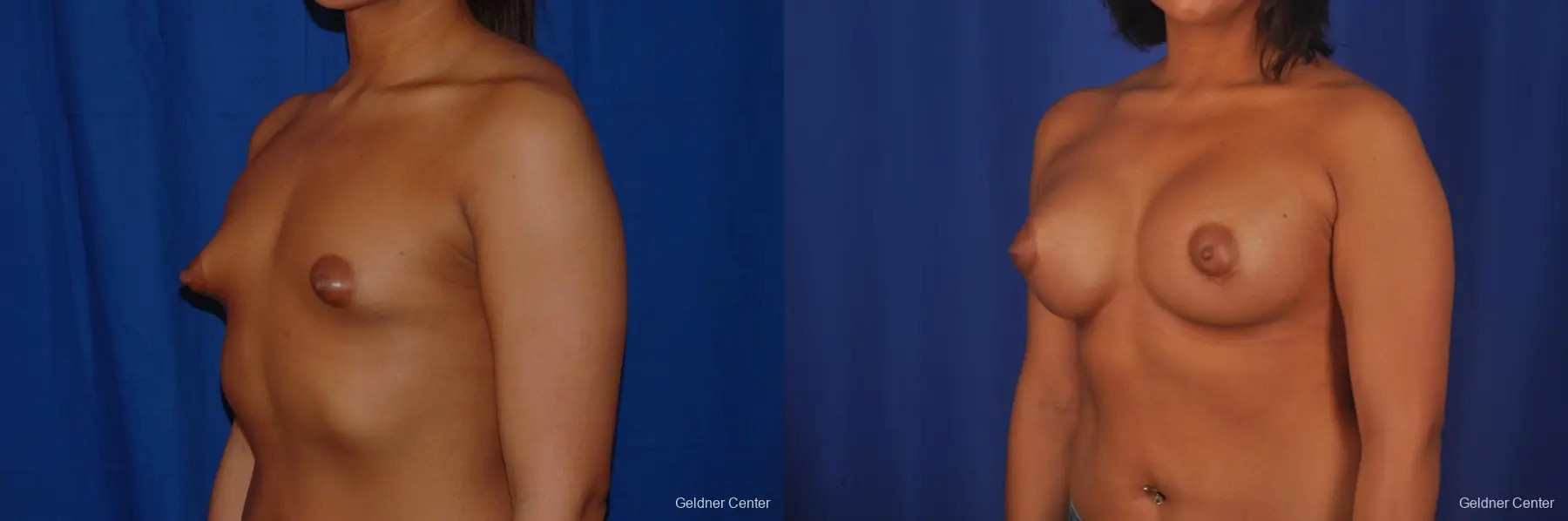 Breast Augmentation: Patient 157 - Before and After 4