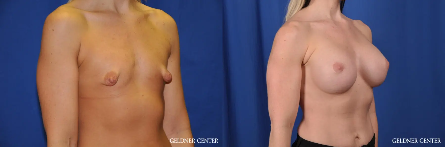 Breast Augmentation: Patient 183 - Before and After 2
