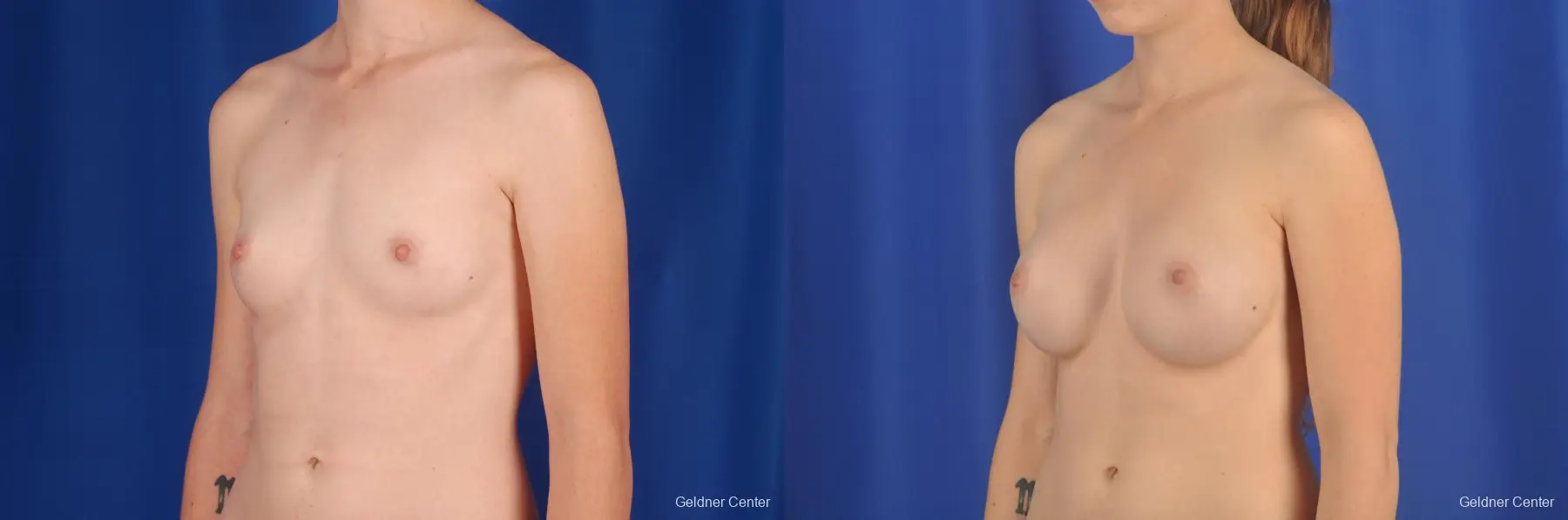 Chicago Breast Augmentation 2304 - Before and After 4