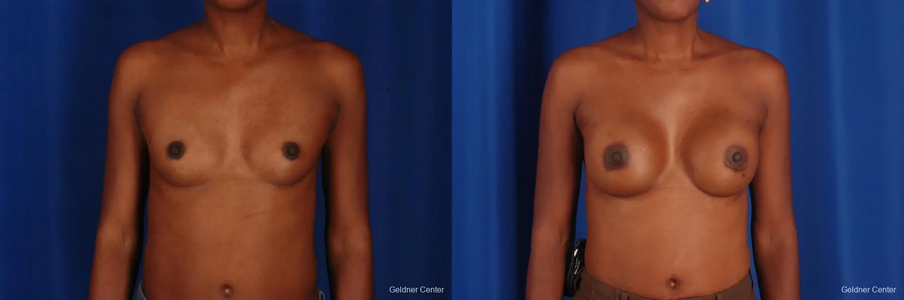 Chicago Breast Augmentation 2293 - Before and After 1
