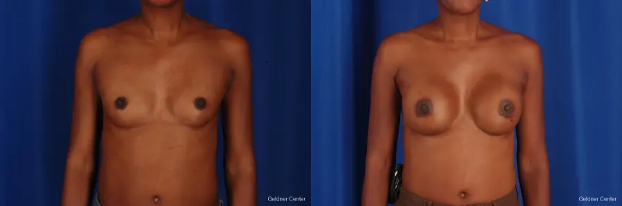 Chicago Breast Augmentation 2293 - Before and After