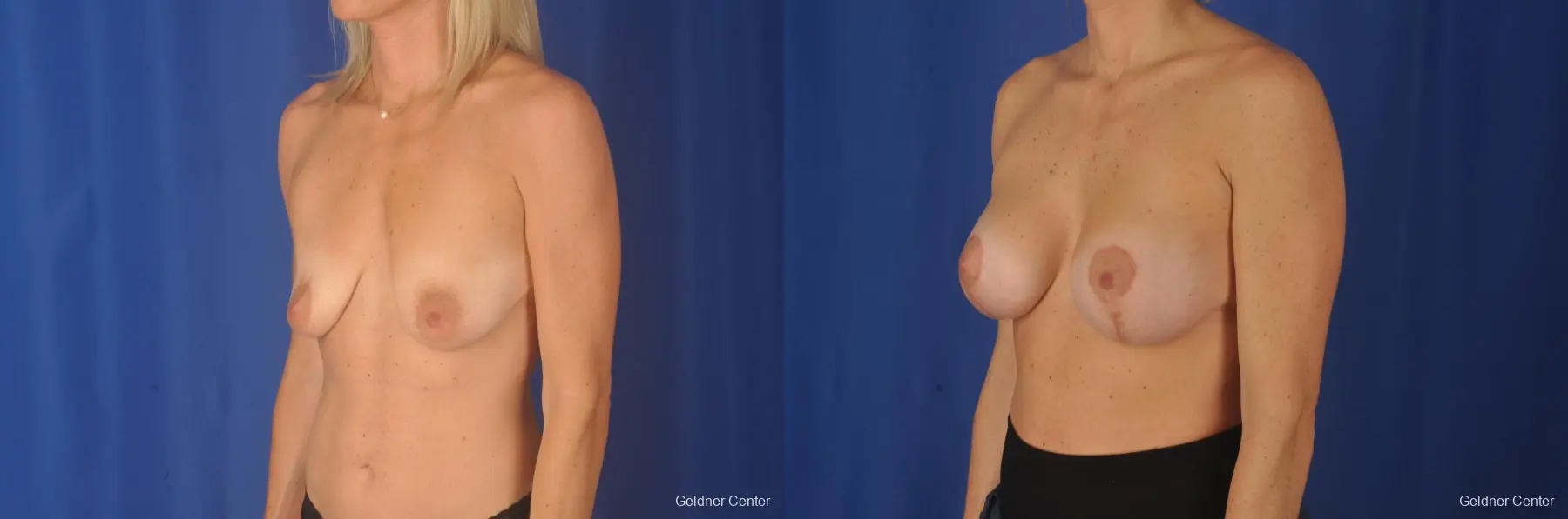Breast Augmentation: Patient 80 - Before and After 4