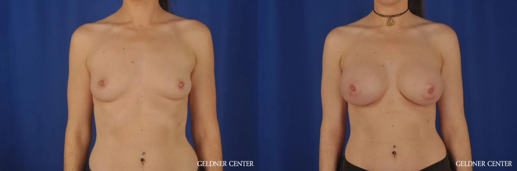 Breast Augmentation Hinsdale, Chicago 5579 - Before and After