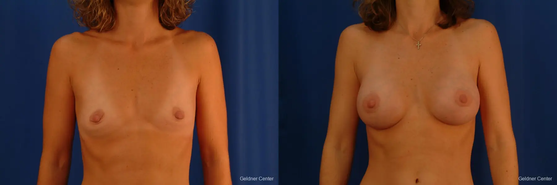 Chicago Breast Augmentation 2442 - Before and After