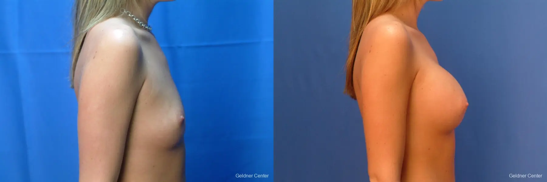Chicago Breast Augmentation 2431 - Before and After 2
