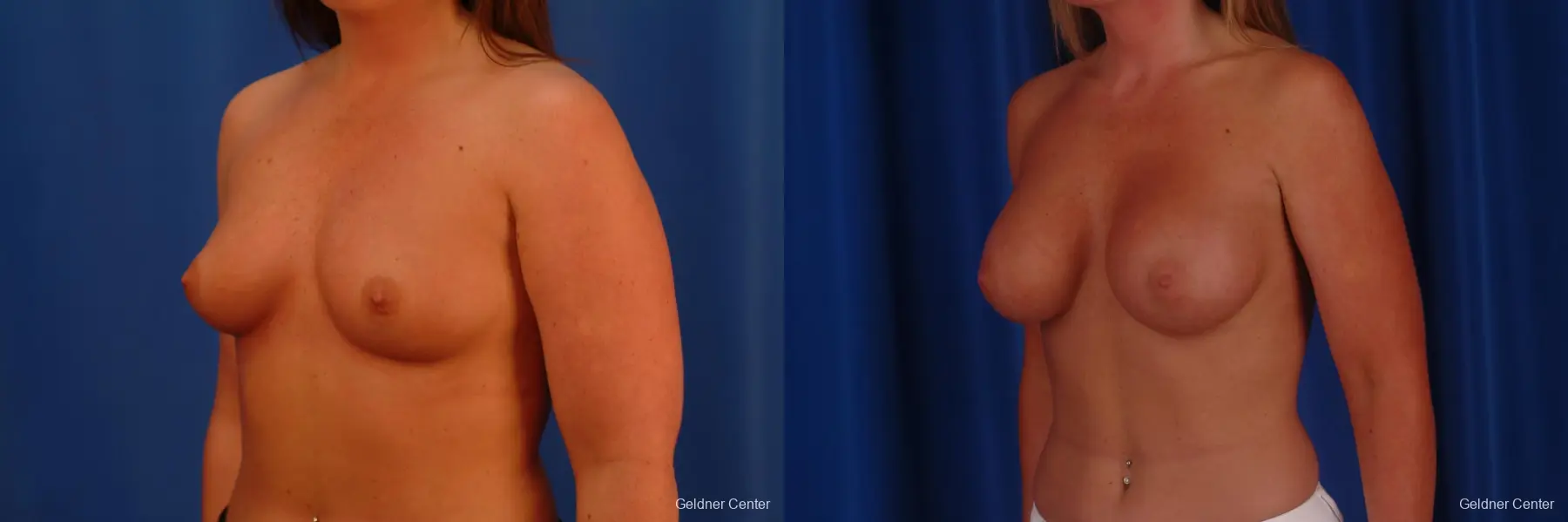 Chicago Breast Augmentation 2636 - Before and After 4