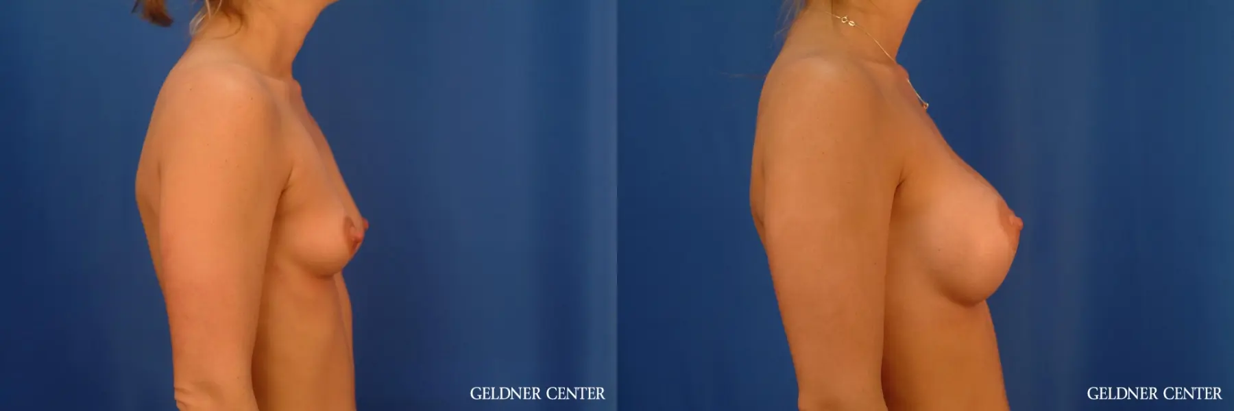 Breast Augmentation: Patient 182 - Before and After 3