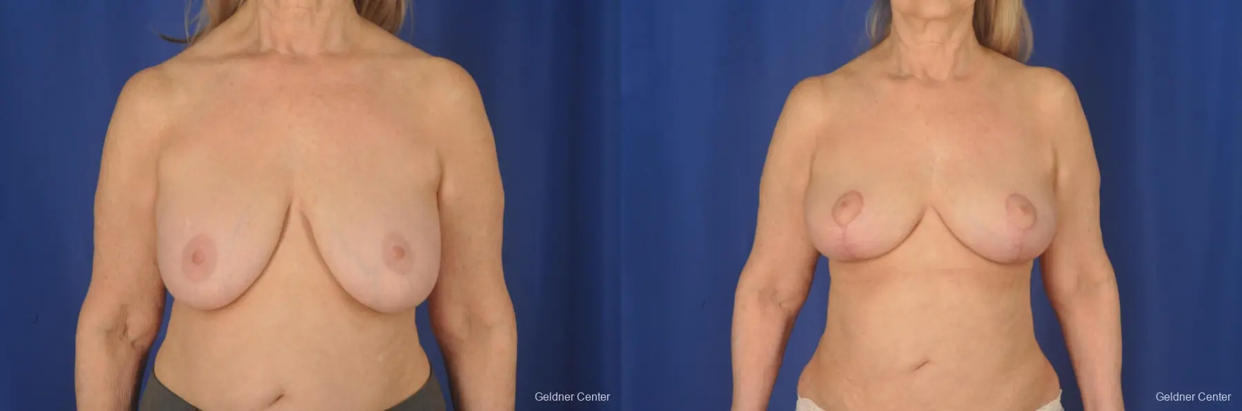 Removal of gel implants, capsulectomy, anchor lift, fat transfer - Before and After