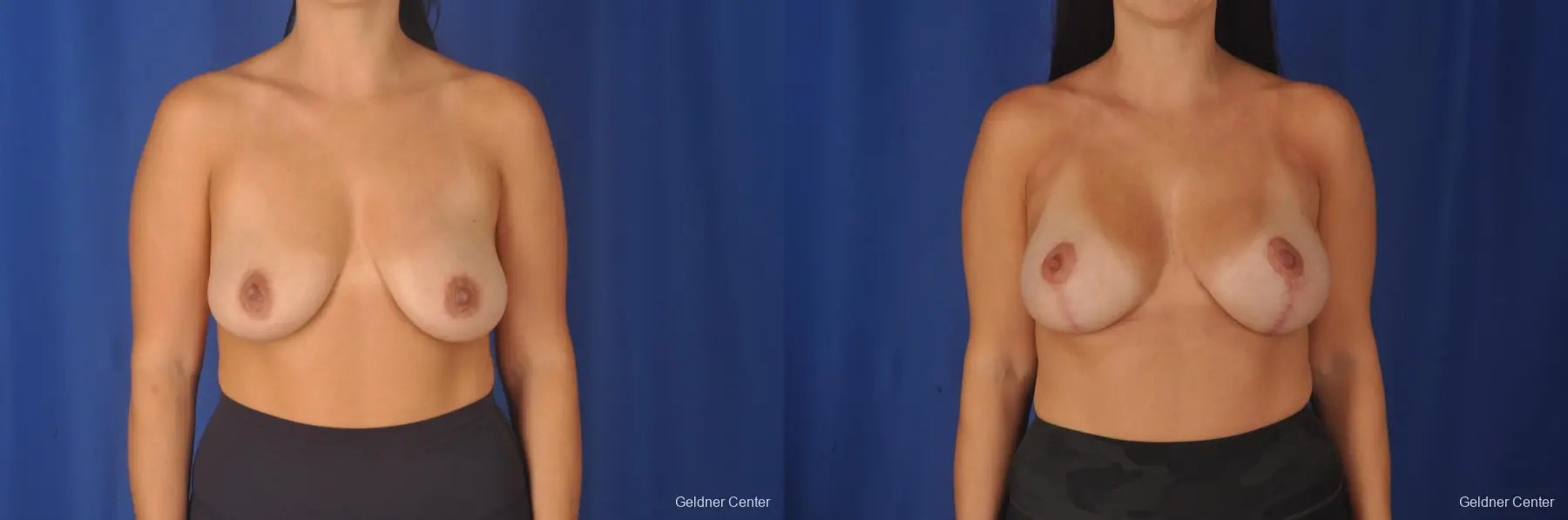 Vertical Masopexy with Subpectpral Biplanar breast Augmentation 250cc - Before and After